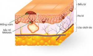 Hậu quả nghiêm trọng khi điều trị nám sai cách